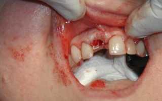 Неприятный запах изо рта после удаления зуба
