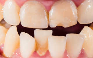 Кривые нижние зубы