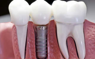 Порядок установки имплантов зубов