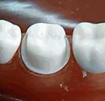 Препарирование зуба под металлокерамическую коронку