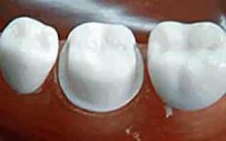 Препарирование зуба под металлокерамическую коронку