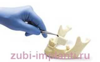 Наращивание кости челюсти под зубной имплант