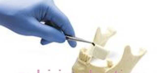 Наращивание костной ткани на нижней челюсти