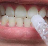 Как пользоваться гелем для отбеливания зубов
