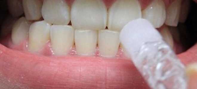 Как пользоваться гелем для отбеливания зубов