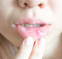 Воспаление слизистой рта и языка