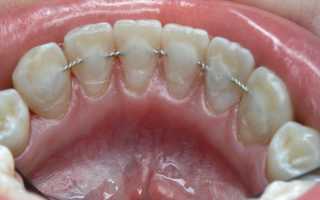 Шинирование в стоматологии