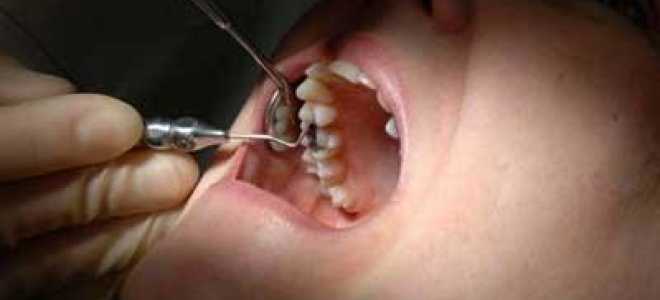 Зубная боль после удаления