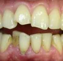 Косметическая реставрация передних зубов
