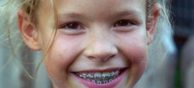 Во сколько лет детям ставят брекеты