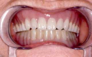 Зубные протезы из силикона