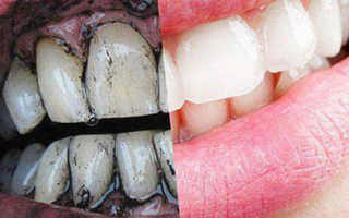 Можно ли активированным углем отбелить зубы