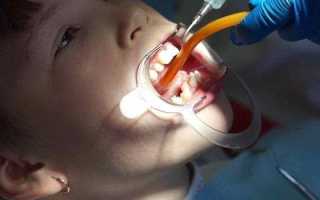 Какой врач подрезает уздечку языка ребенку