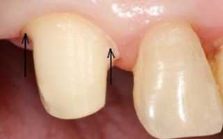 Обтачивание зубов под коронки