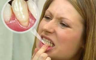 Воспаление десны между зубами