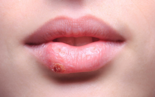 Воспаление слизистой губ