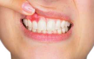 Что такое свищ в зубе
