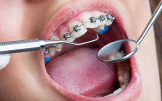 Можно ли лечить зубы в брекетах