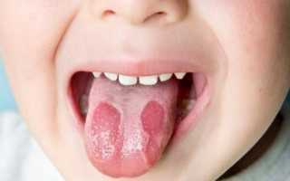 Белые пятна на языке у ребенка