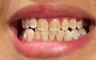 Почему желтеют зубы
