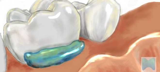 Что такое аппликационная анестезия в стоматологии