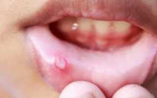 Воспаление во рту на щеке