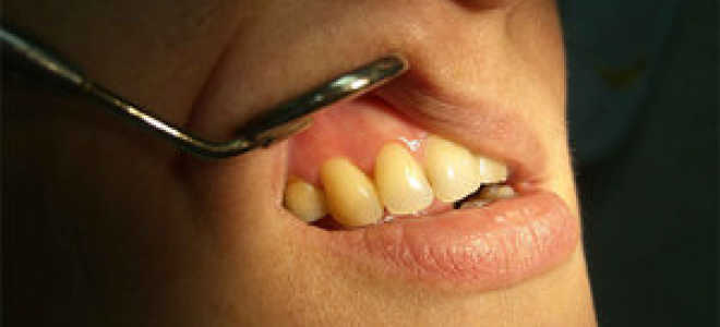 Как выглядит киста на снимке зуба