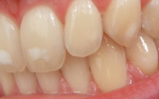 Почему на зубах белые пятна