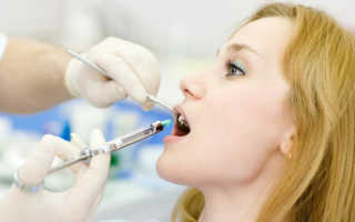 Местная анестезия в стоматологии