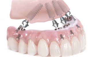 Синус лифтинг использование при имплантации зубов