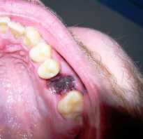 После удаления зуба боль не проходит