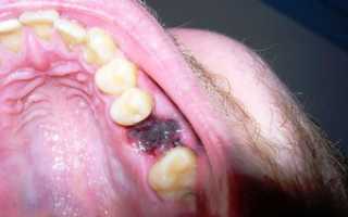 После удаления зуба боль не проходит