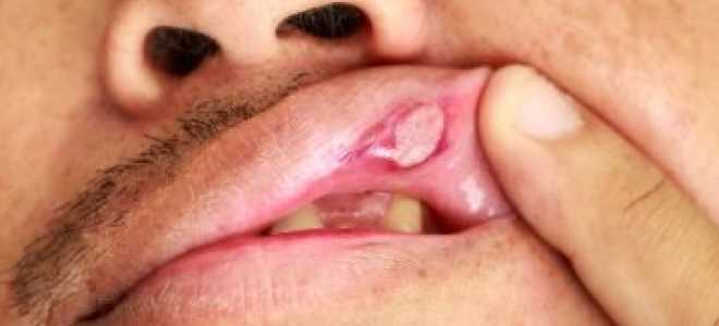 Чем лечить язвочки