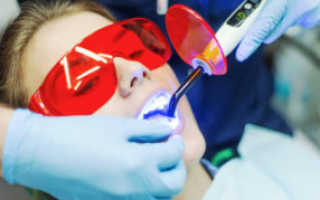 Способы отбеливания зубов в стоматологии
