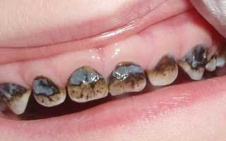Зубы после серебрения