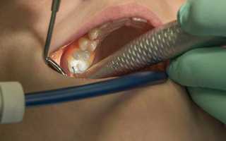 Обезболивание при лечении зубов при беременности