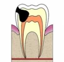 Перфорация канала зуба симптомы