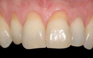 Почему оголяются зубы возле десен