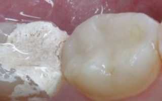 Мышьяковистая паста в стоматологии