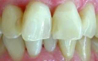 Фарфоровые виниры на зубы