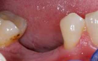 Процесс заживления после удаления зуба