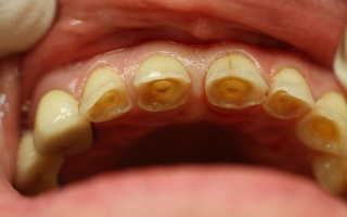 Лечение гиперестезии зубов