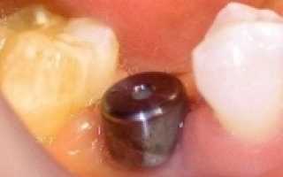 Этапы имплантации зубов формирователь десны